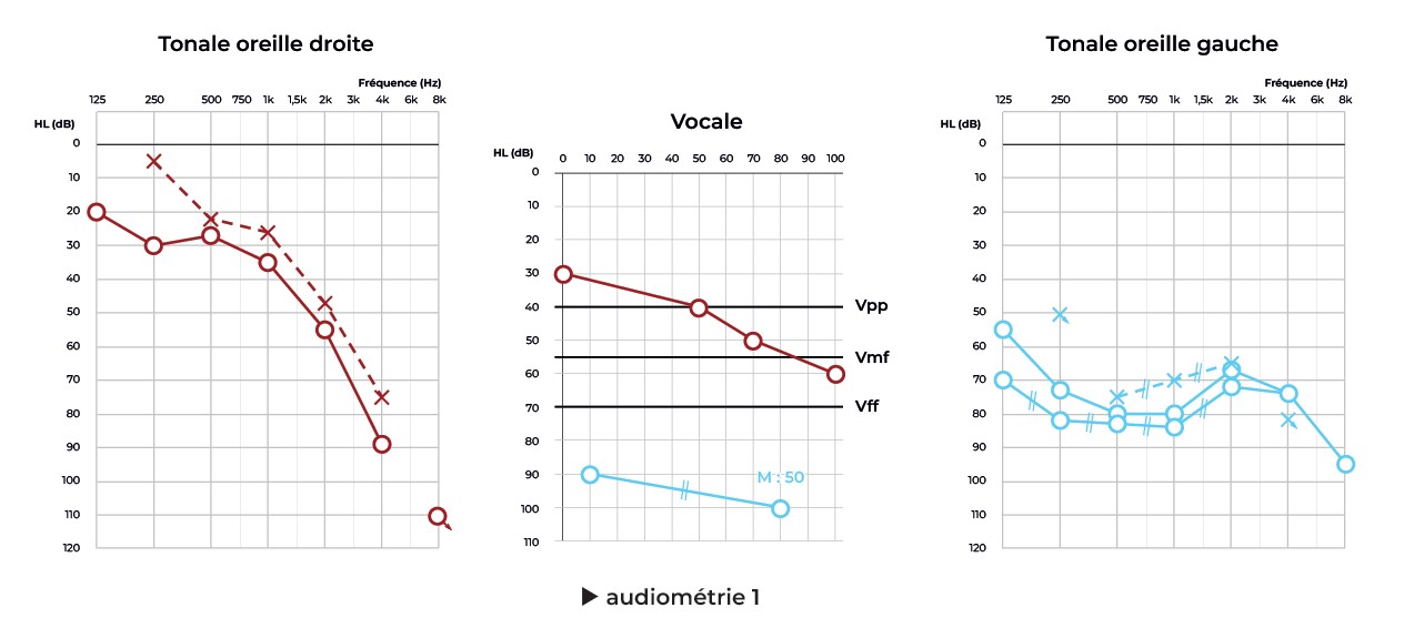 audiometrie1
