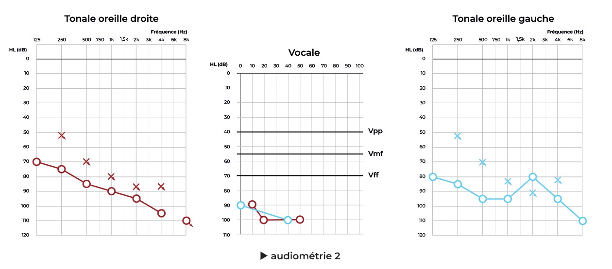 audiometrie2