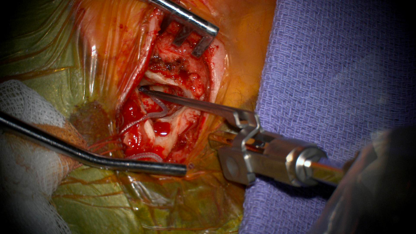 insertion lente et stable